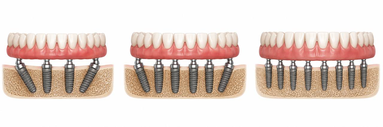 All-on-4 vs All-on-6 vs All-on-X implant comparison diagram, number of implants per arch