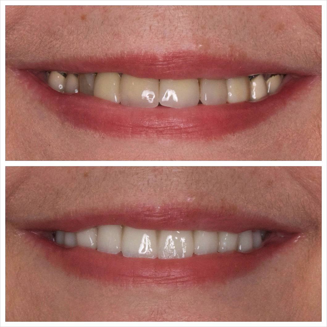 Patient with a confident smile after same day All-on-X dental implants at Noland Implants & Aesthetics in Heber Springs, Arkansas