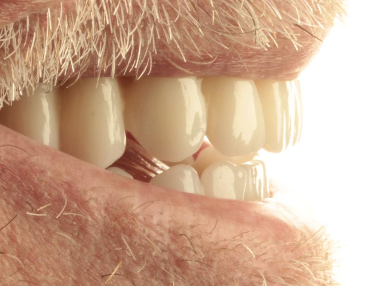 Close-up of custom zirconia final arch, Noland Implants & Aesthetics