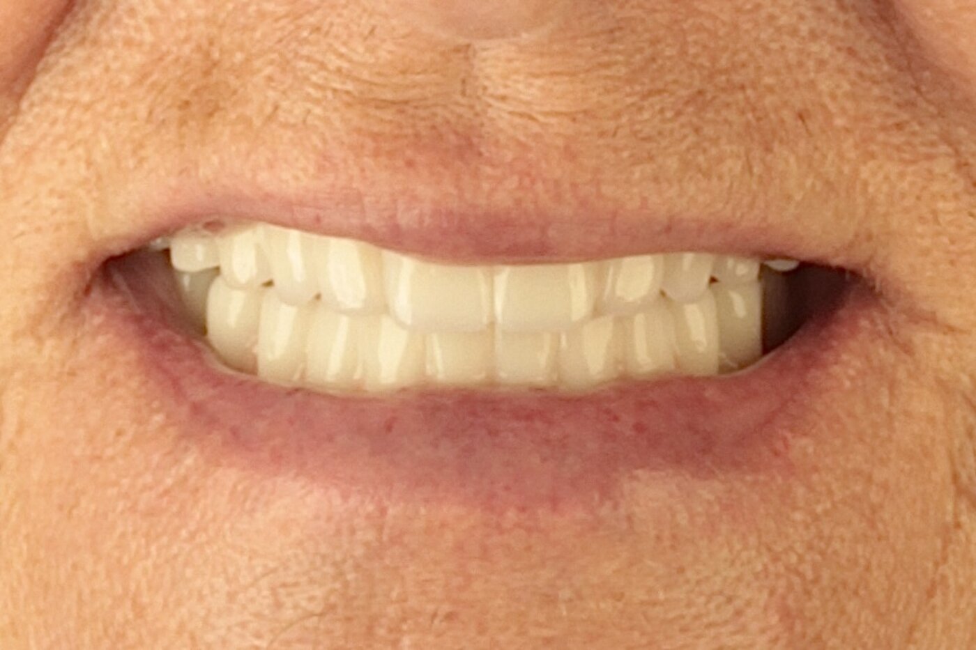 Patient after full arch dental implant treatment — full smile restored