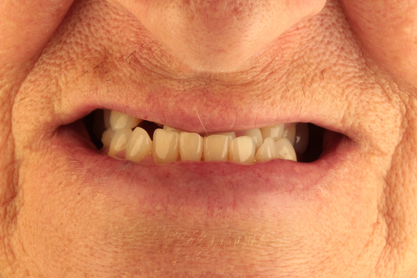 Patient before full arch dental implant treatment — advanced tooth loss