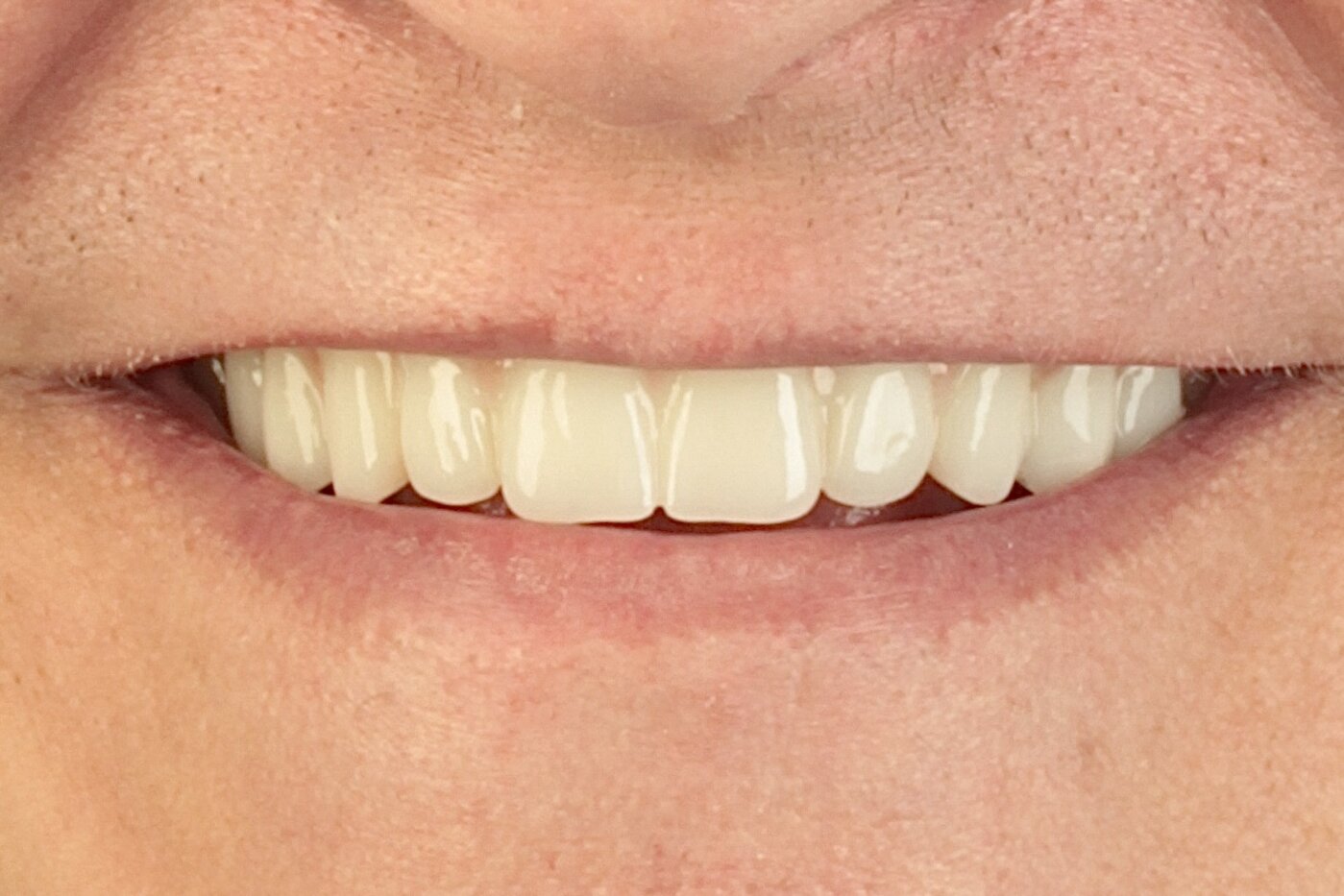 Patient after full arch dental implant treatment — full smile restoration
