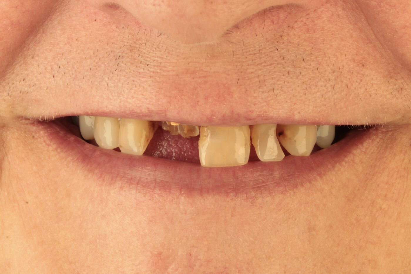 Patient before full arch dental implant treatment — complete tooth loss
