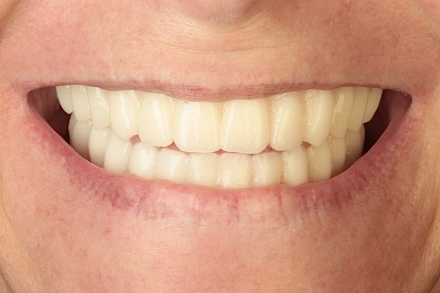 Patient after full arch dental implant treatment — full smile restoration