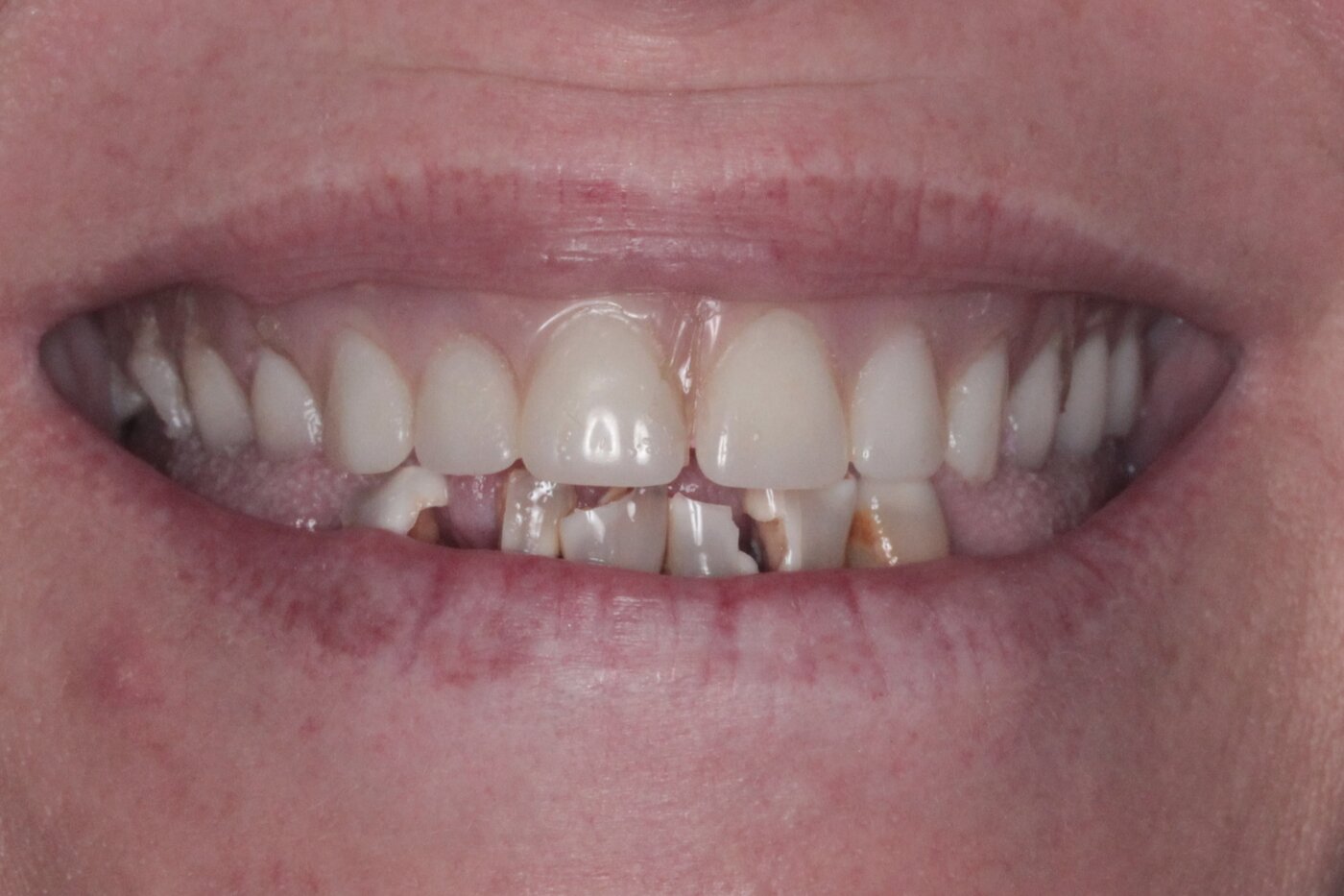 Patient before full arch dental implant treatment — failing and damaged dentition