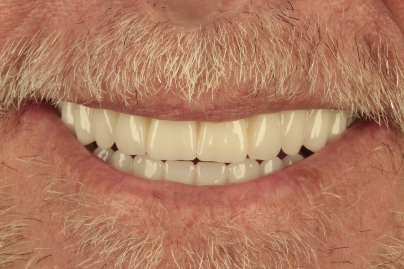 Patient after full arch dental implant treatment — complete smile restoration