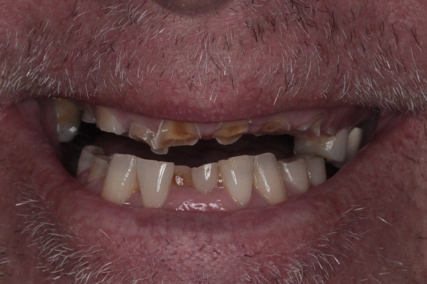 Patient before full arch dental implant treatment — worn and damaged teeth