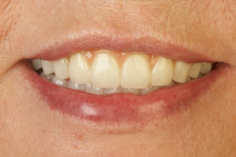 Patient after dental implant treatment — full arch restoration