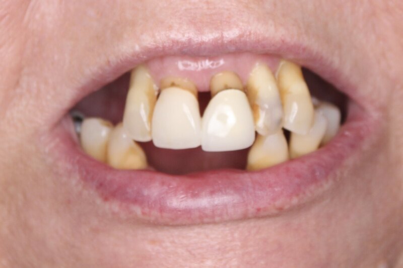 Patient before dental implant treatment — misaligned and deteriorating teeth
