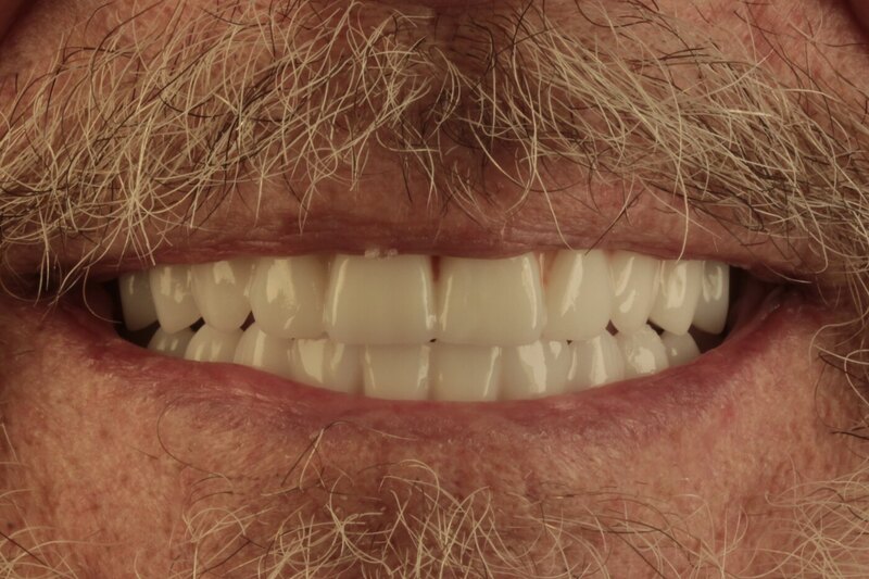 Patient after dental implant treatment — complete arch restoration