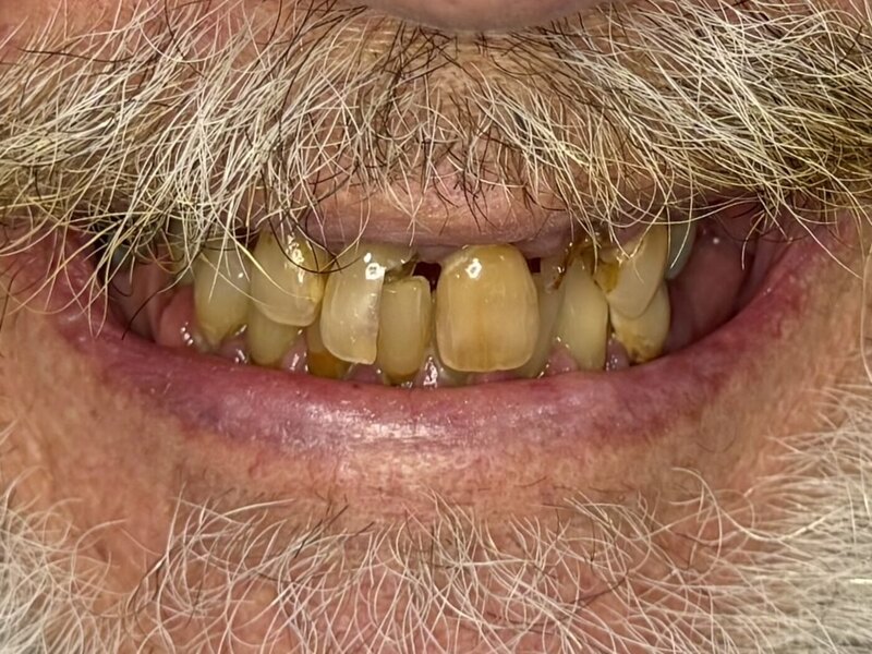 Patient before dental implant treatment — severely damaged dentition